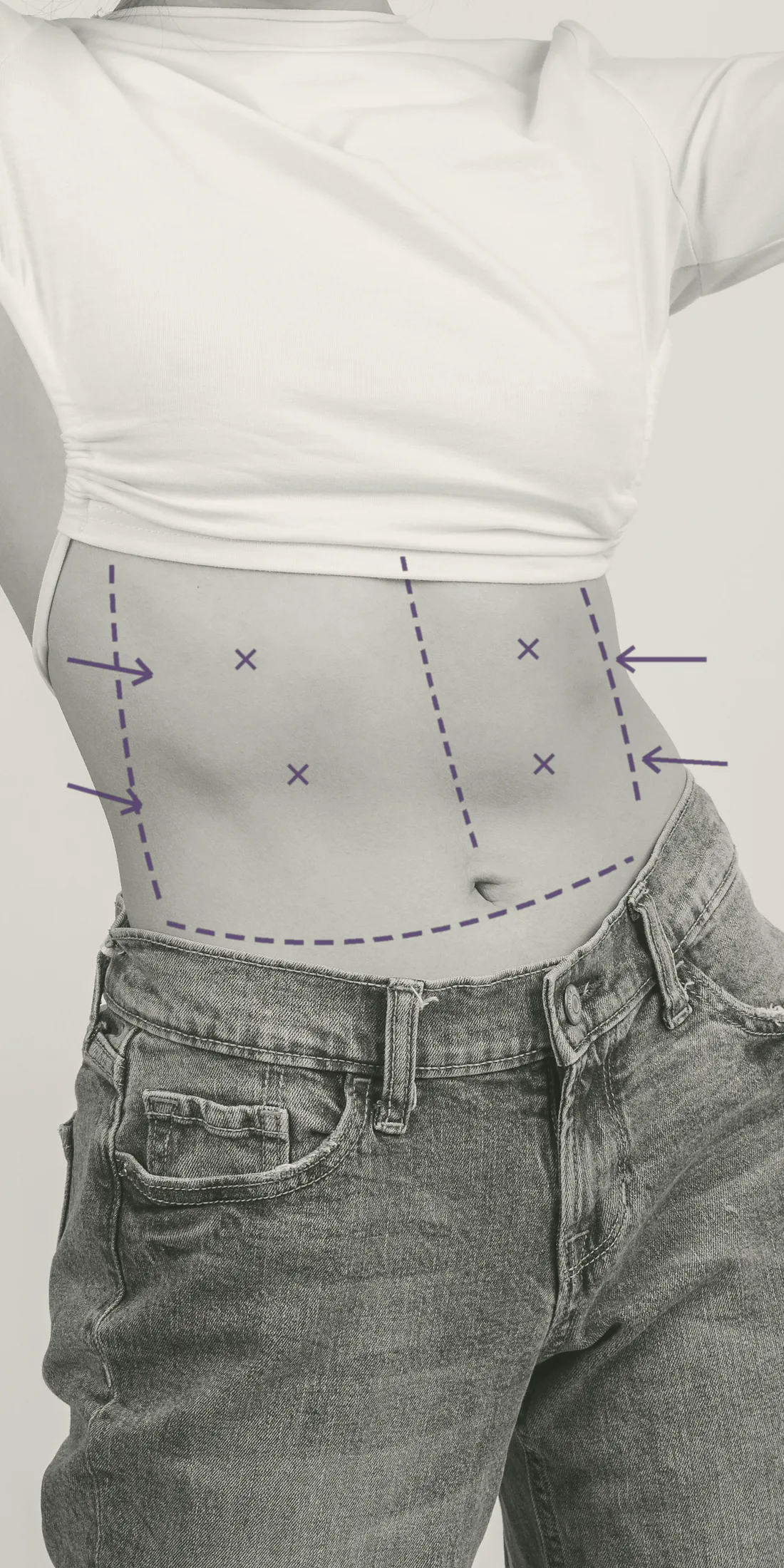 Torso de una mujer con líneas de marcación quirúrgica dibujadas en la cintura y el abdomen